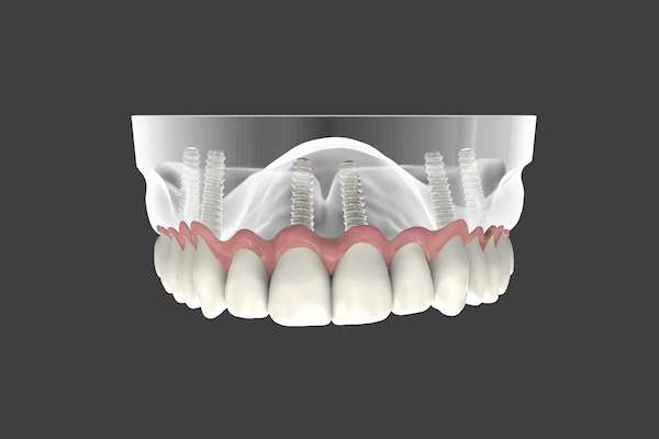 Are Implant Supported Dentures Permanent from Joyful Dental Care in Chicago, IL