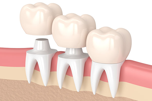 Three Tips to Deal With a Loose Dental Crown from Joyful Dental Care in Chicago, IL