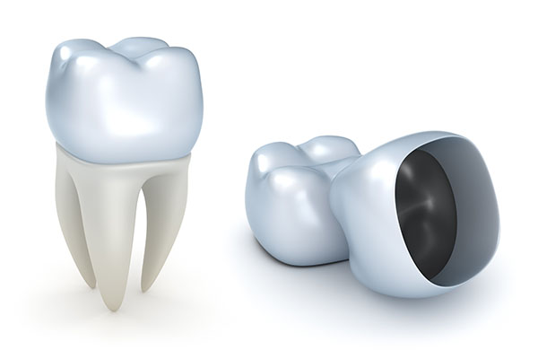 Is a Dental Crown Recommended for Dealing with a Cracked Tooth? from Joyful Dental Care in Chicago, IL