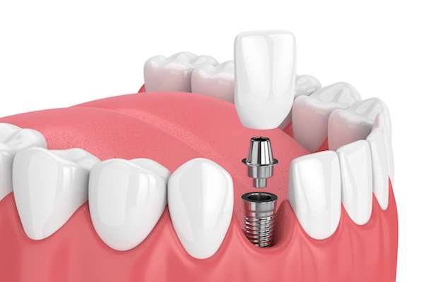 How Painful is Dental Implant Surgery from Joyful Dental Care in Chicago, IL