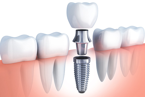 Questions to Ask Your Implant Dentist from Joyful Dental Care in Chicago, IL