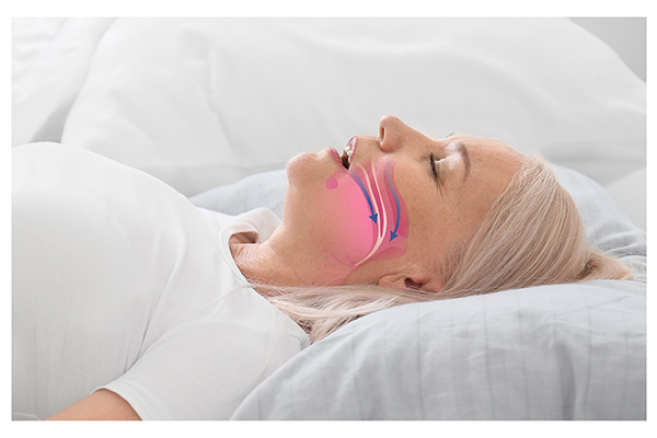 Reasons To Treat Sleep Apnea With A Dental Oral Appliance
